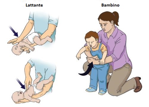 disostruzione viee aeree